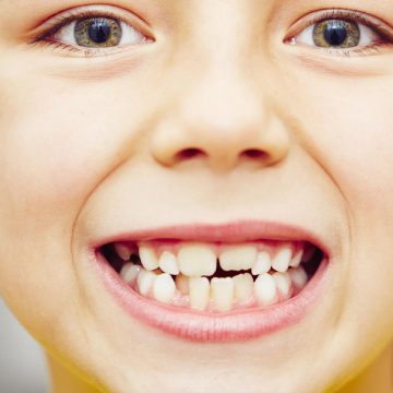 What Are Dental Sealants, and Should My Child Have Them?