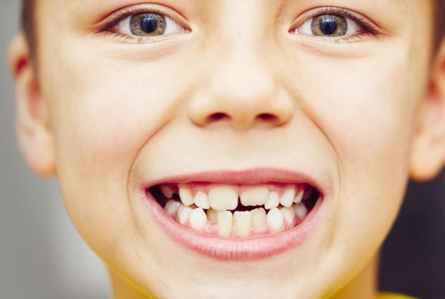 What Are Dental Sealants, and Should My Child Have Them
